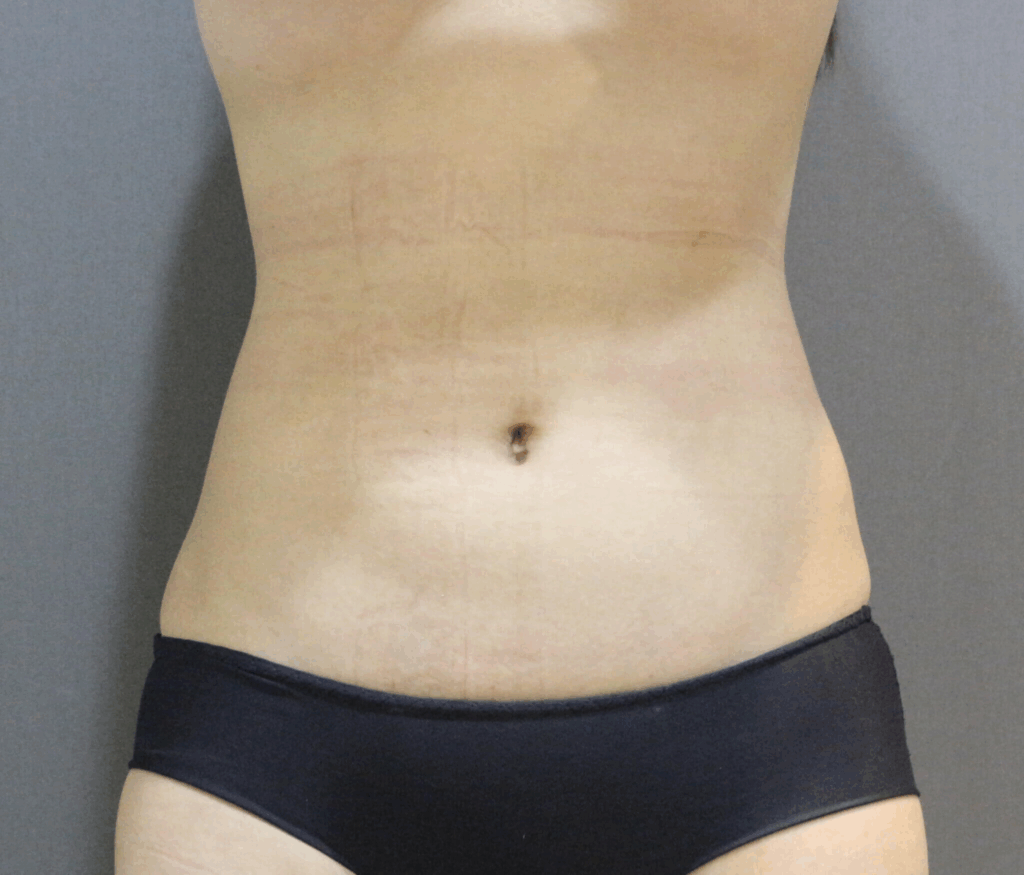 威塑手術後：腹部平坦緊緻，馬甲線隱約可見，腰線分明，展現優雅身形