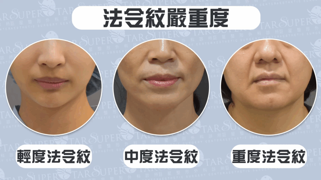 法令紋嚴重度分級