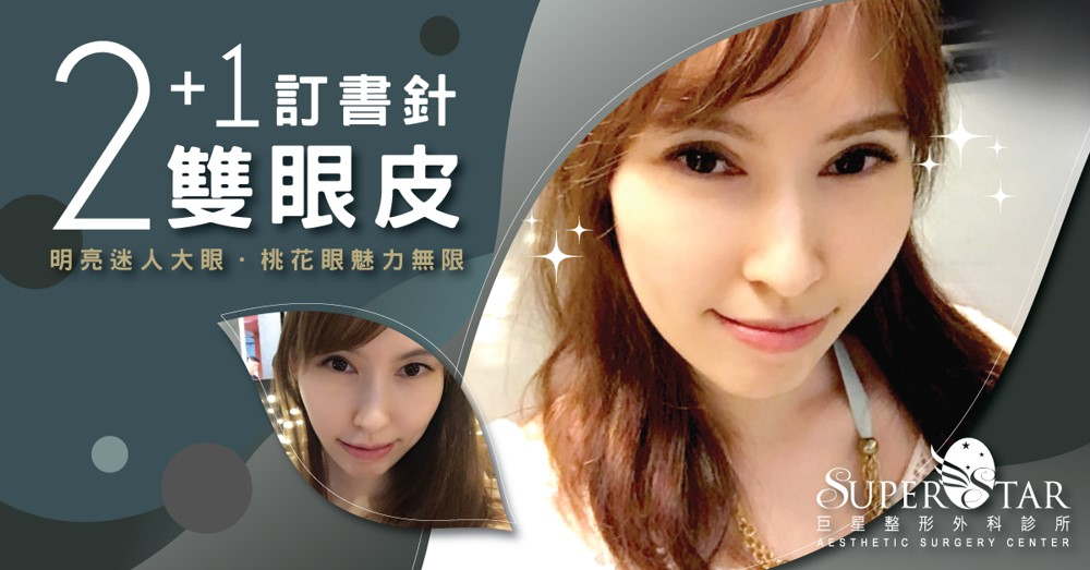 混血萌雙眼皮手術-2+1訂書針術式