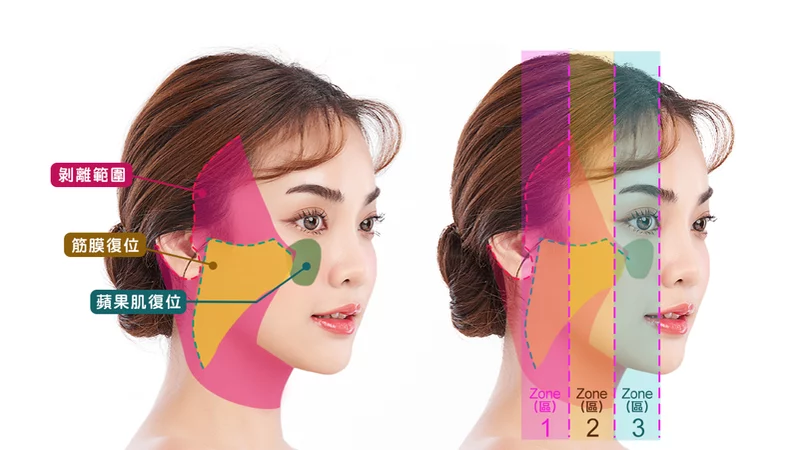 「全層次結構式拉皮」傷口隱痕　效果維持更長久！