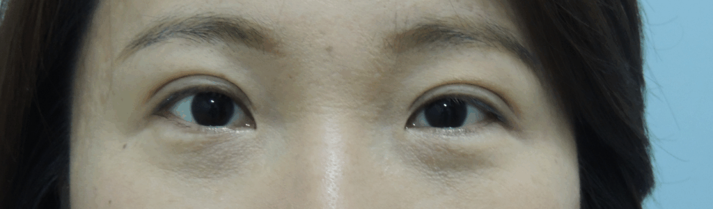 混血萌雙眼皮手術案例-張眼有神