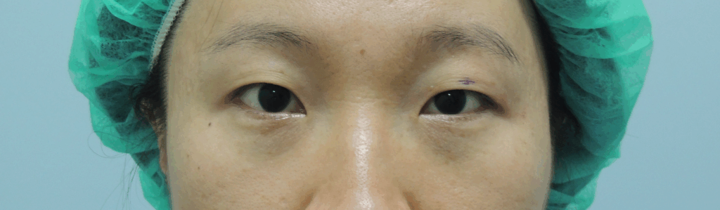 混血萌雙眼皮手術案例-閉眼無痕