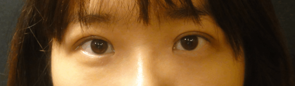 混血萌雙眼皮術後
