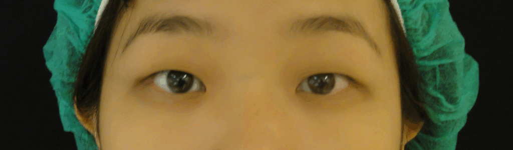 混血萌雙眼皮術前