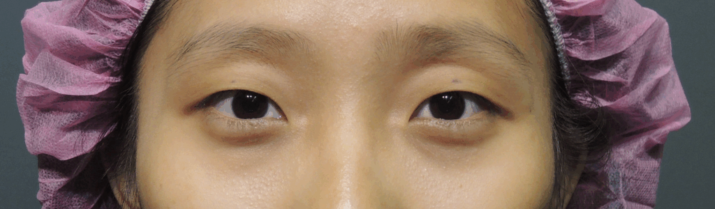 混血萌雙眼皮改善眼型