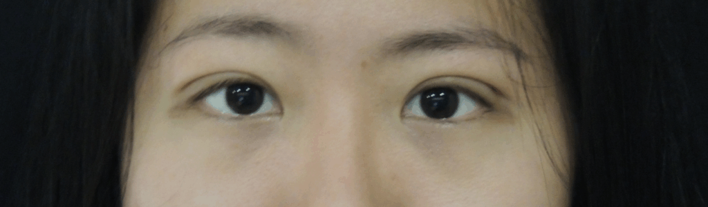 混血萌微創泡泡眼術後