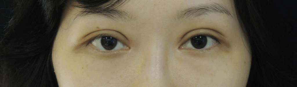 混血萌雙眼皮搭配開眼頭術後