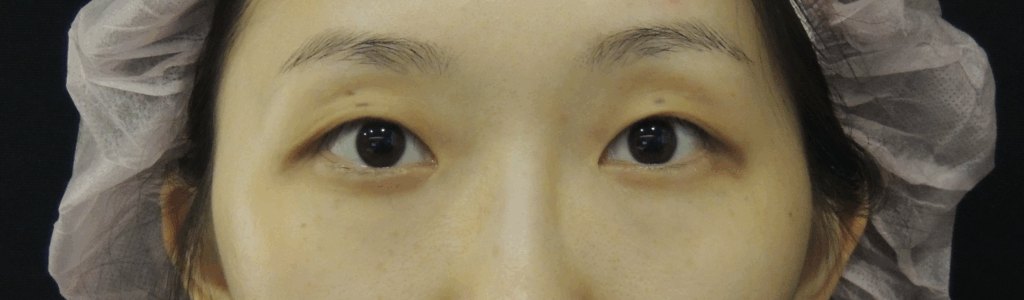 混血萌雙眼皮搭配開眼頭術前