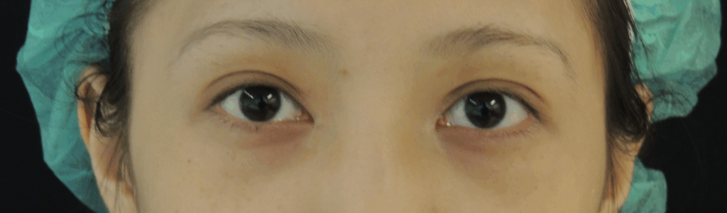 混血萌雙眼皮術後案例