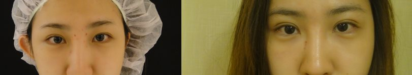 混血萌雙眼皮-自然深邃