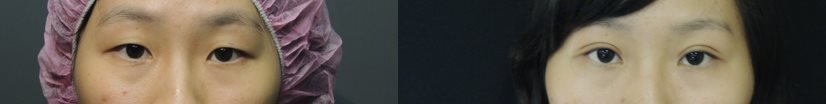 混血萌雙眼皮-改善無神