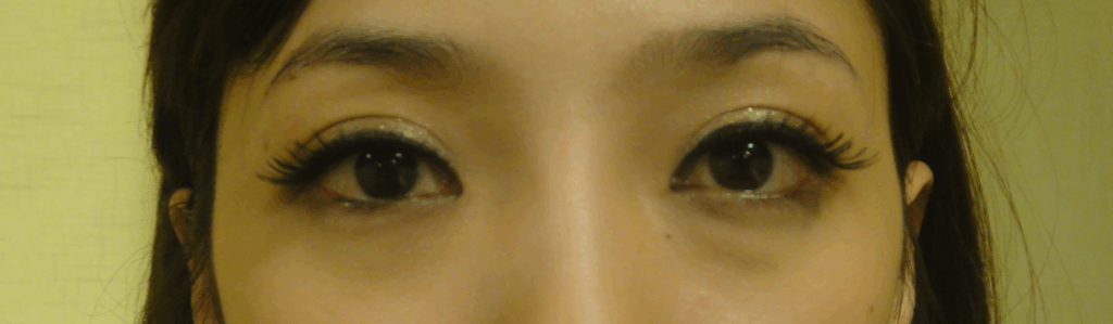 混血萌雙眼皮術後對比