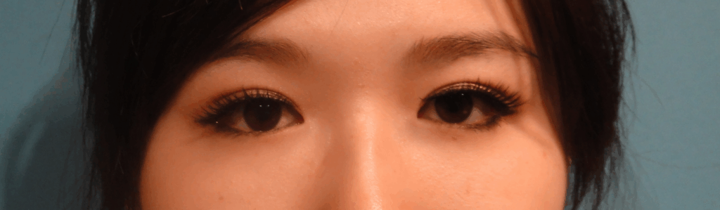 混血萌雙眼皮術後