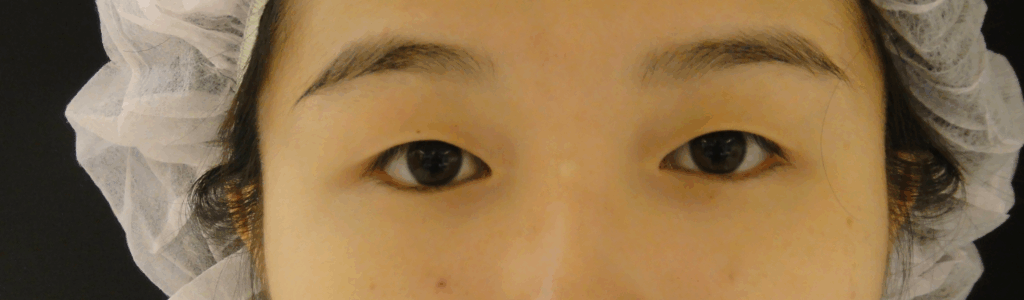 混血萌雙眼皮術前