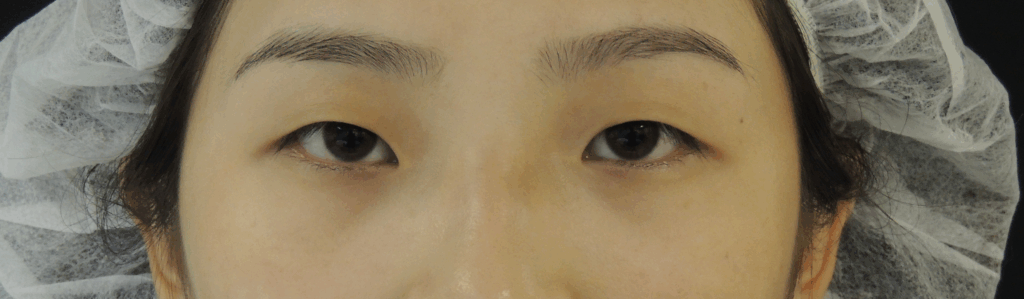 混血萌雙眼皮術前