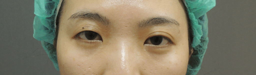 混血萌雙眼皮術前