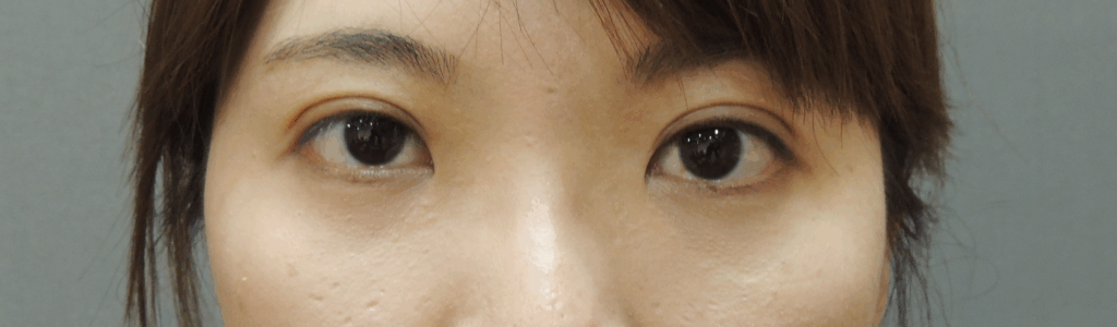 混血萌雙眼皮術後