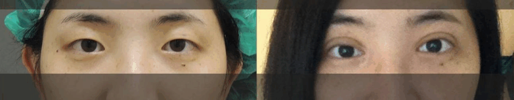 混血萌雙眼皮-眼神放大