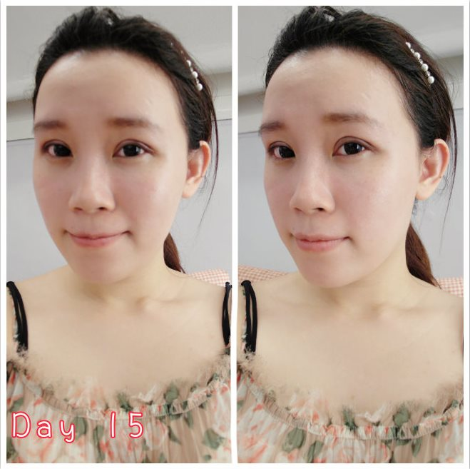 部落客推薦混血萌雙眼皮術前