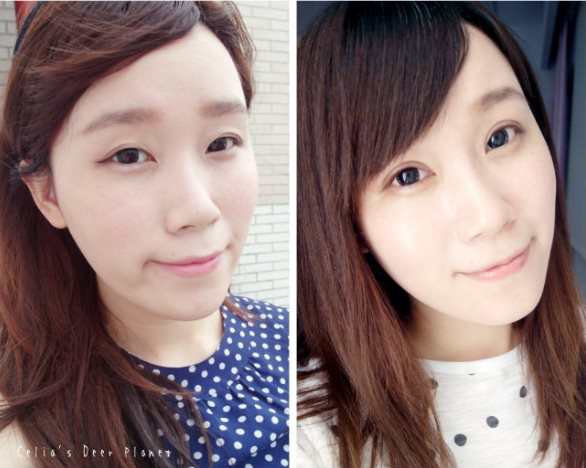 部落客推薦混血萌雙眼皮術後