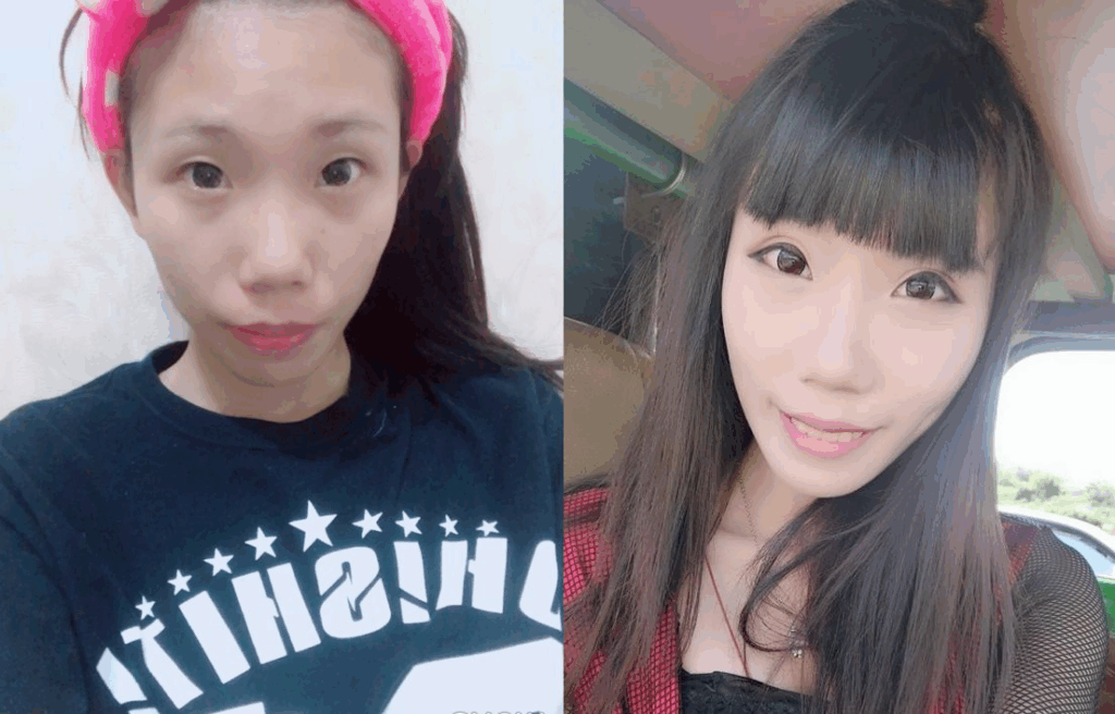 泡泡眼改善對比