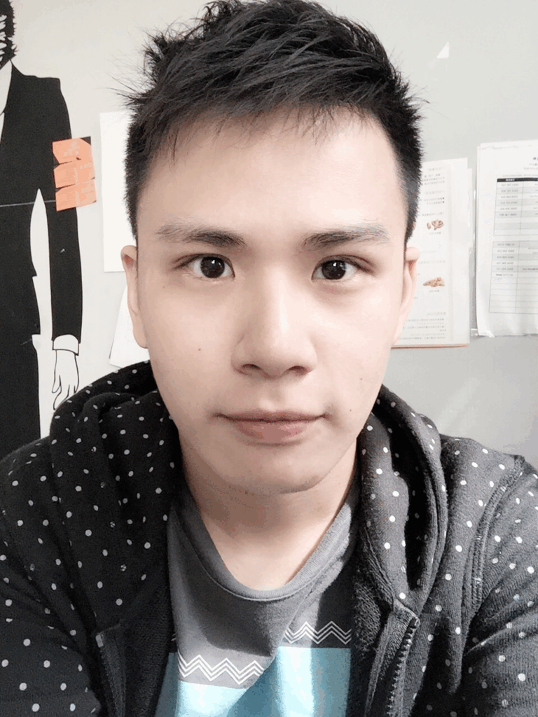 顧小瑋術後-混血萌雙眼皮