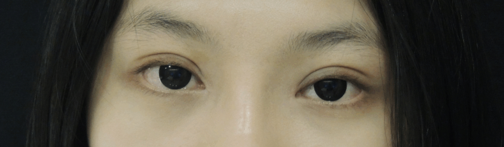 混血萌雙眼皮+開眼頭術後