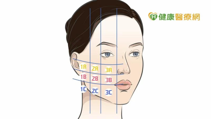 改善中下臉法令紋、木偶紋 「全層次結構式拉皮」跨越顴骨 緊緻更到位