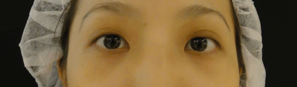 混血萌雙眼皮術前