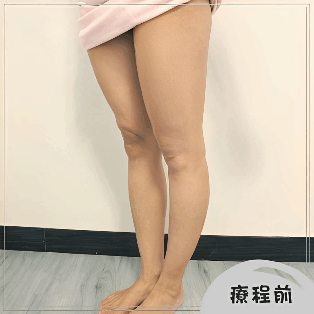 療程前大腿照