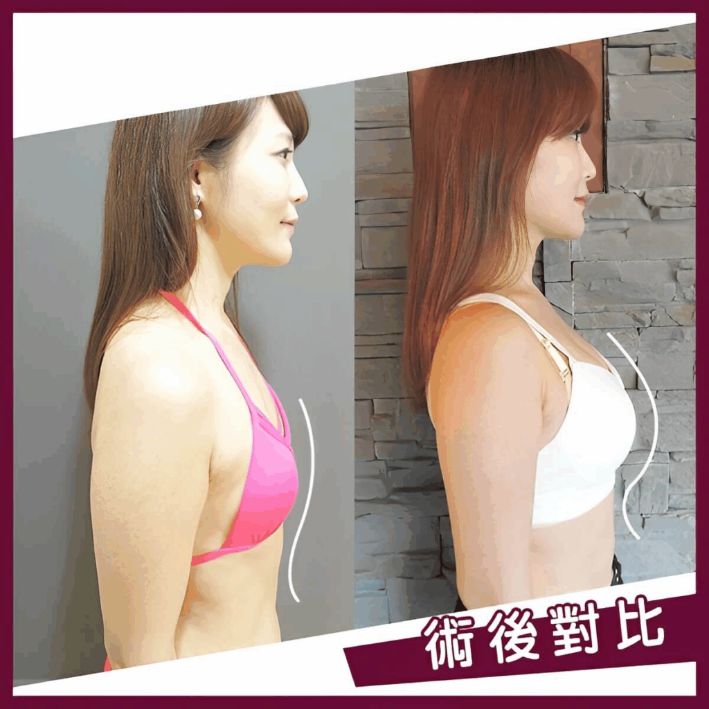 術後對比照(胸部)
