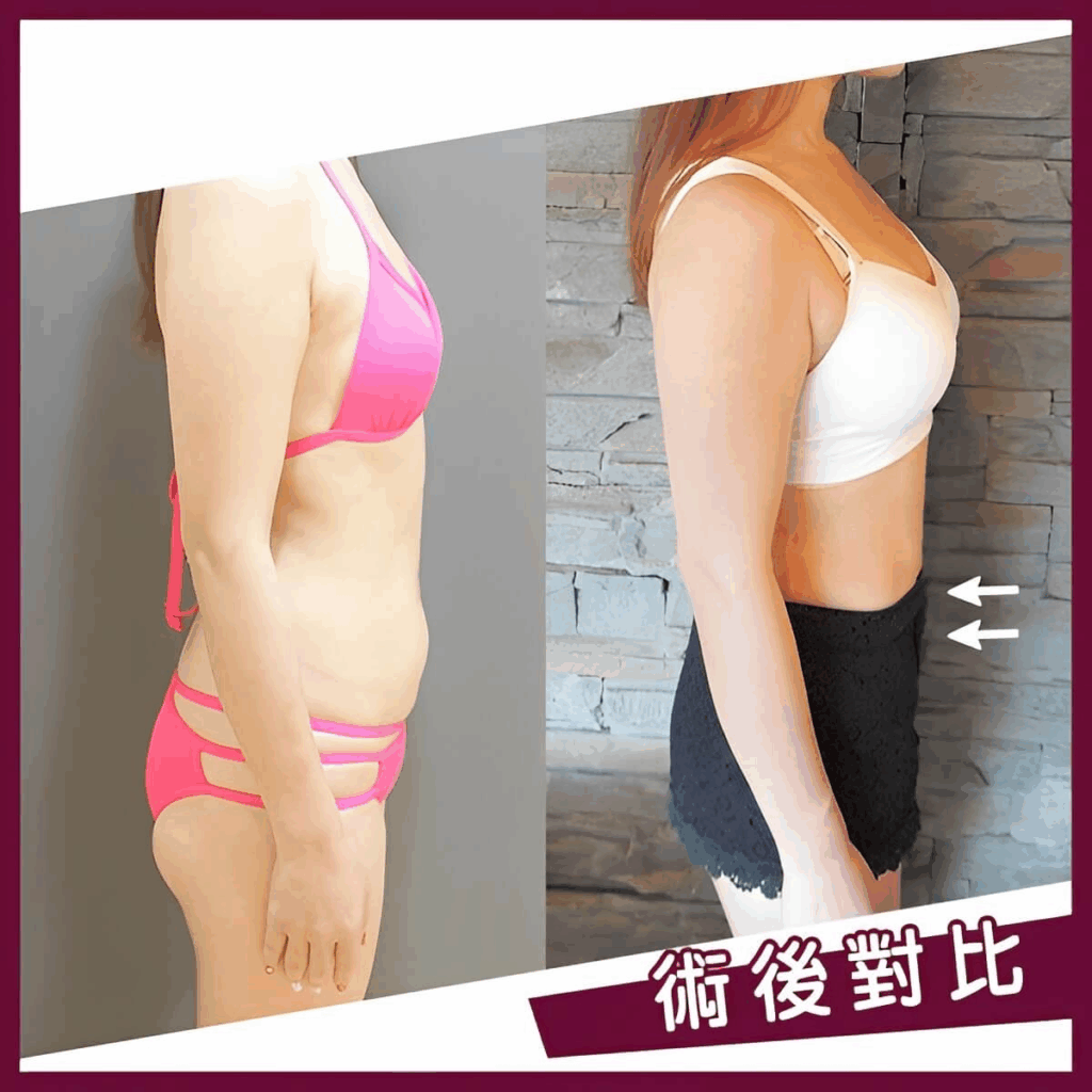 術後對比照(肚子)