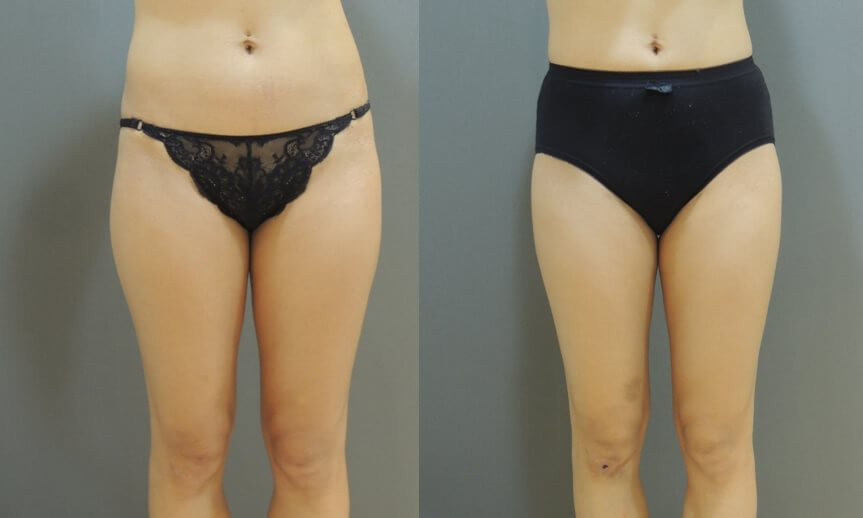 威塑大腿抽脂術後：粗壯大腿變細，腿型更直，穿起短裙熱褲線條更修長