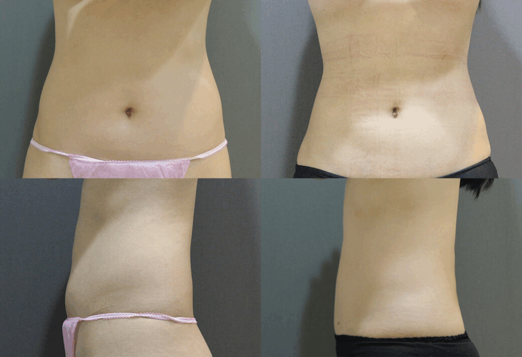 威塑體雕術前術後觀察