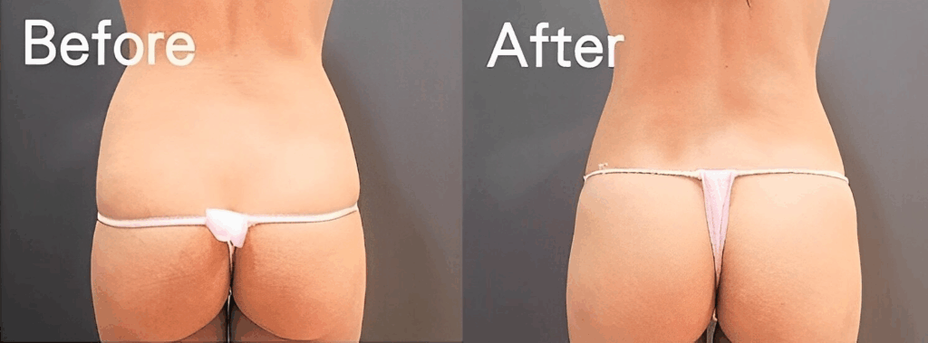 術前術後對比照