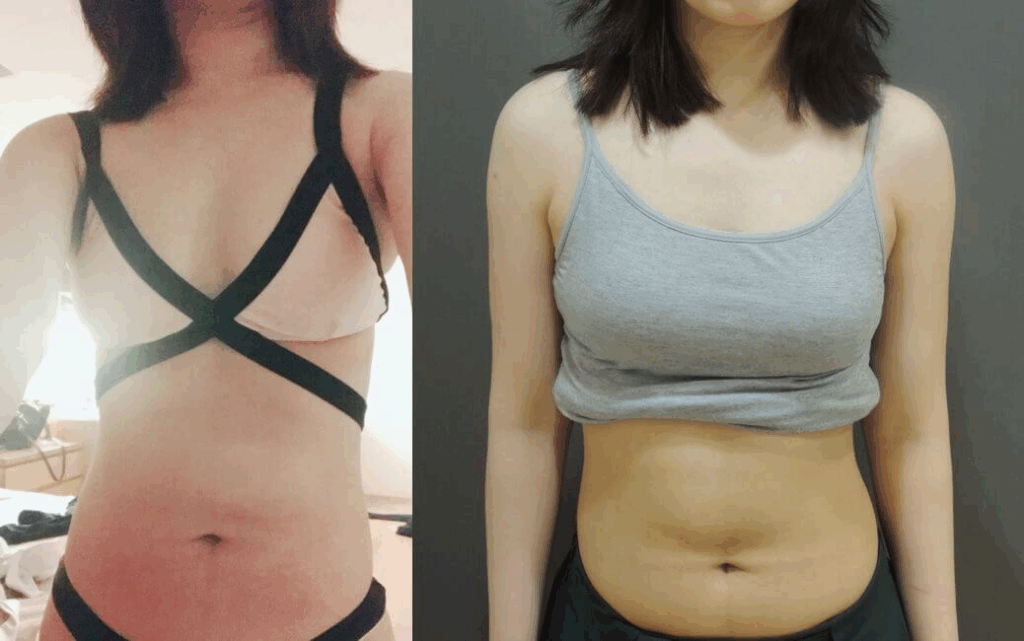 術前術後比對照