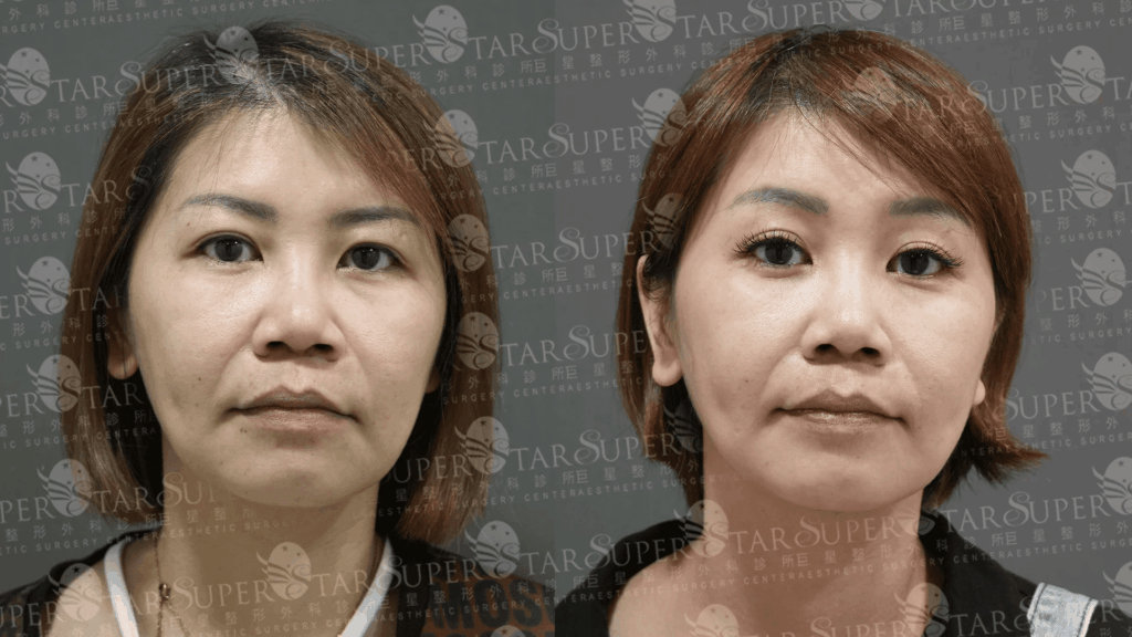 內視鏡提眉案例2