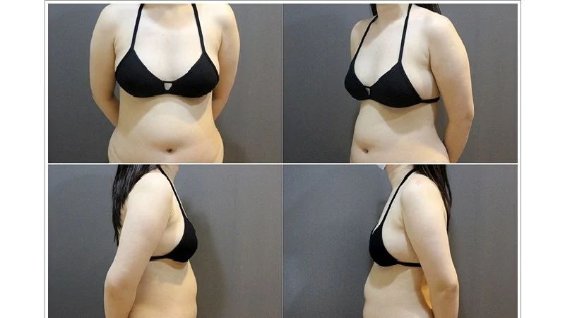 術前各角度照片