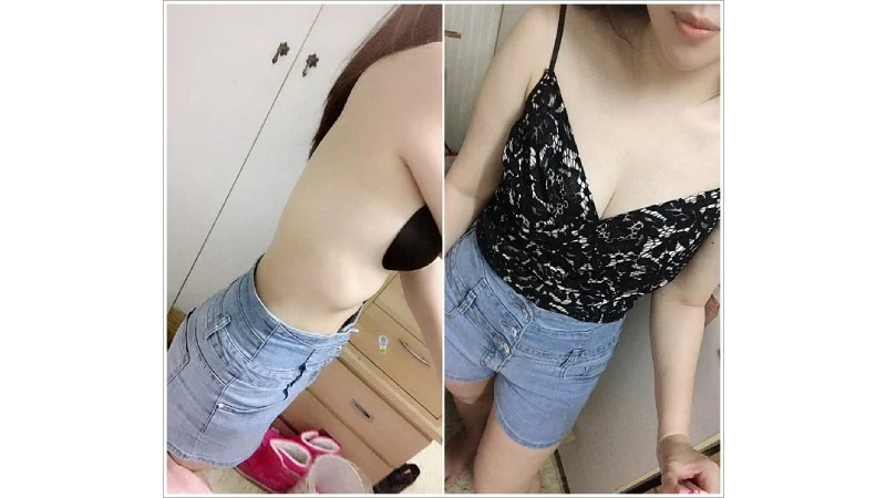 自體隆乳照