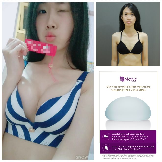 CASE 2：Motiva 魔滴隆乳 (飽滿胸型)