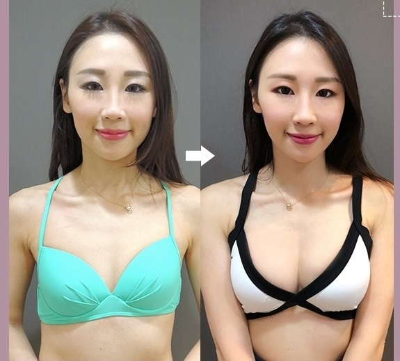 更多二代雙面複合式隆乳案例