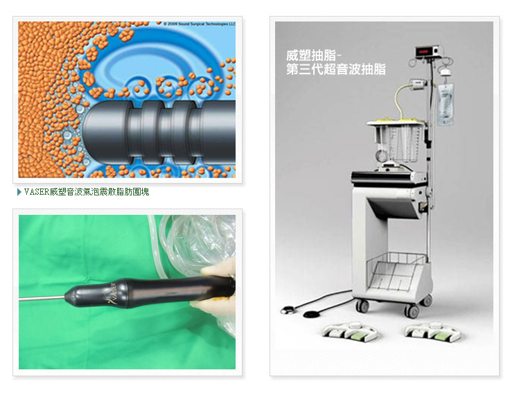 塑抽脂以音波氣泡震離脂肪，維持脂肪細胞完整性 [威塑抽脂]