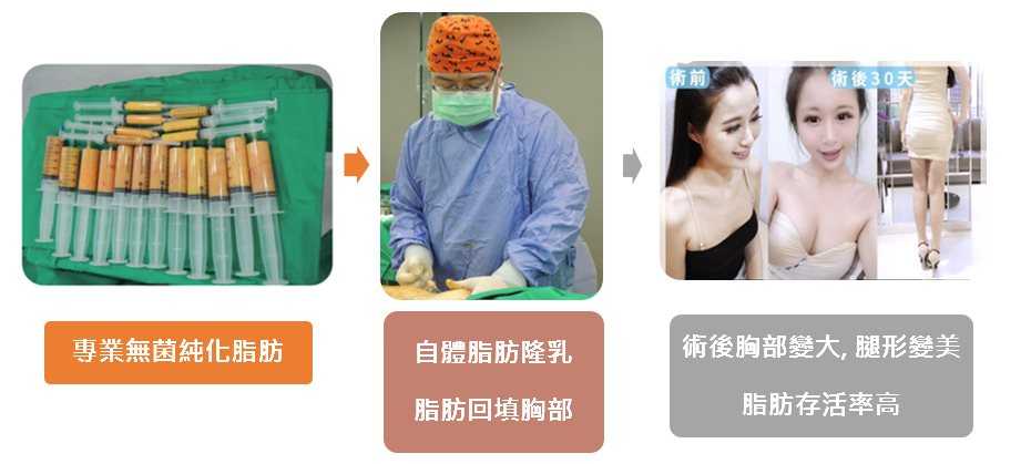 自體脂肪隆乳手術流程2