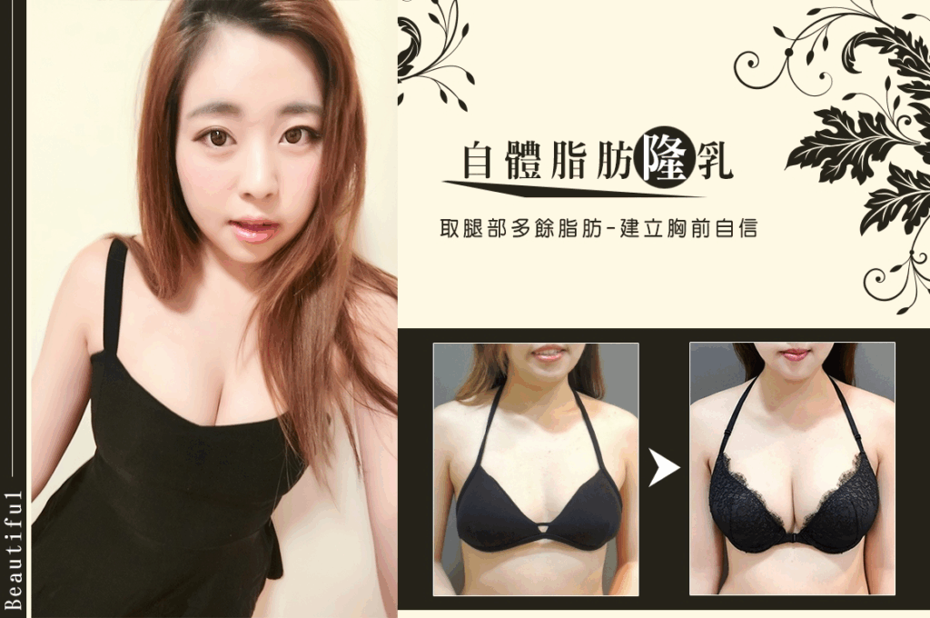 威塑自體脂肪隆乳 (大腿抽脂 + 360 度環形抽脂)