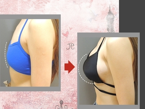 雙面蜜桃絨隆乳 (果凍矽膠)2