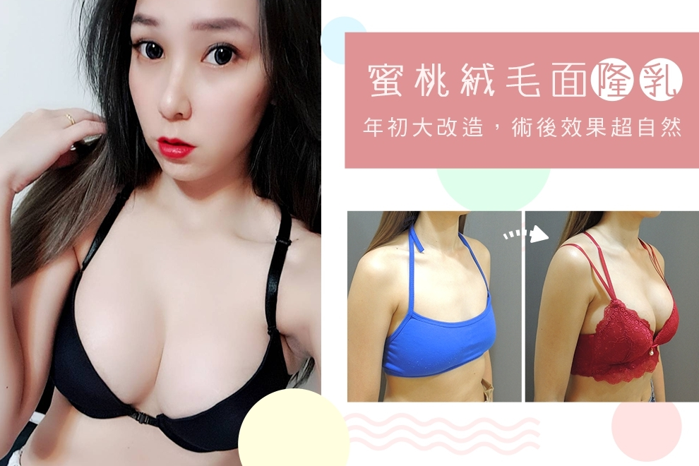 CASE 2 產後胸部萎縮 - 蜜桃絨果凍隆乳 300CC (A → D)
