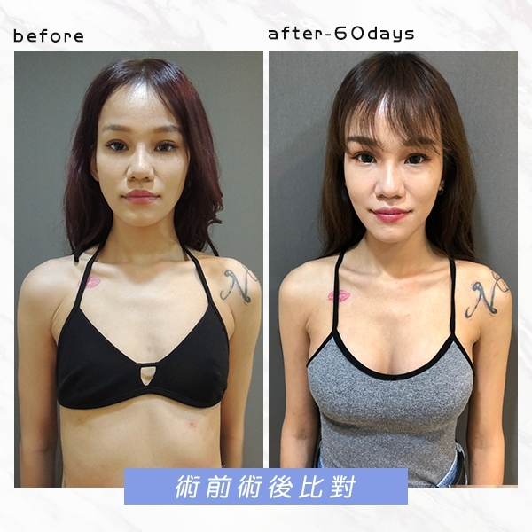術前術後比對照1