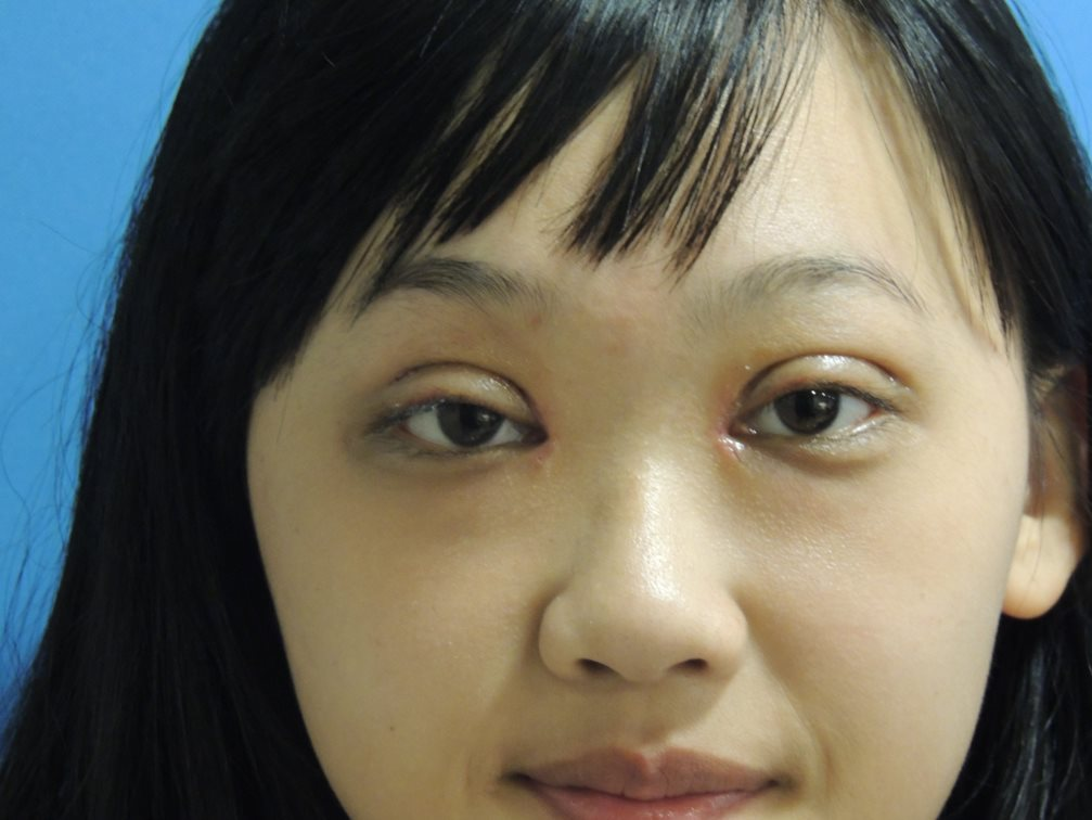 術後 1 週：恢復期紀錄