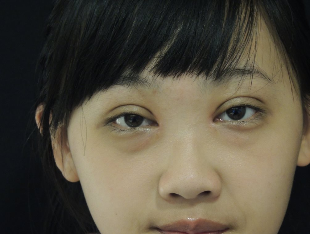 術後 2 週：線條漸顯