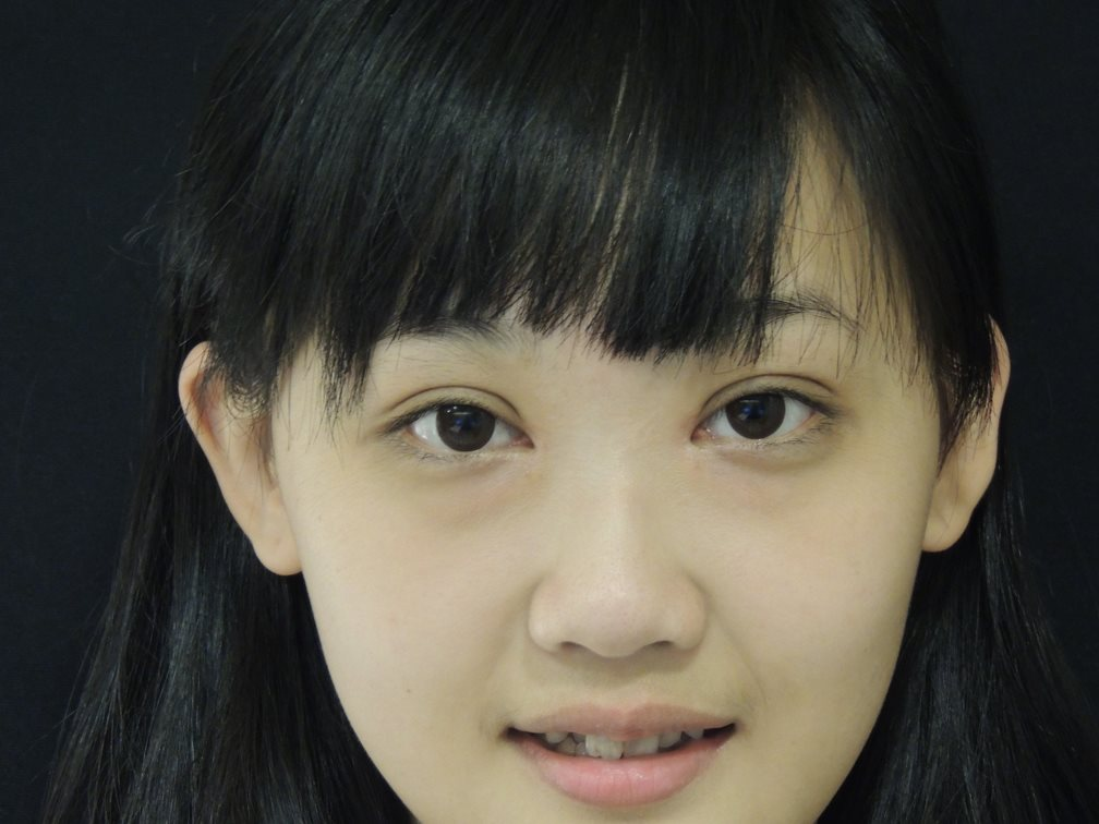 術後 1.5 個月：定型期